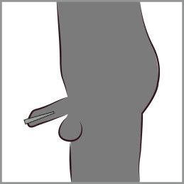 Stepped Dilator