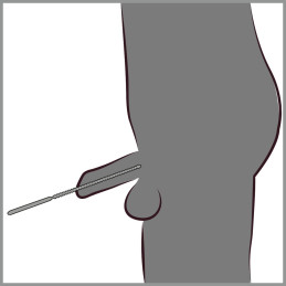 Ribbed Dilator